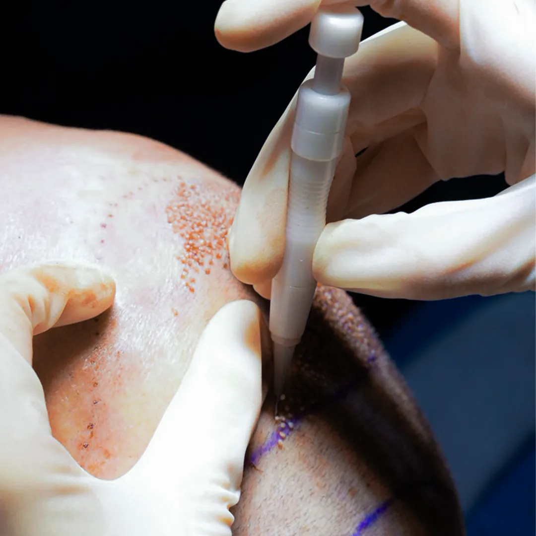 DHI hair transplant in Lahore using an implanter pen for graft placement